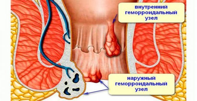 Лечение Зуд в заднем проходе в Николаеве проктолог Рябец